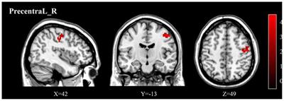 Alteration of Whole Brain ALFF/fALFF and Degree Centrality in Adolescents With Depression and Suicidal Ideation After Electroconvulsive Therapy: A Resting-State fMRI Study